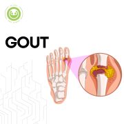 GOUT